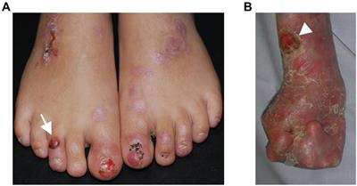 Dystrophic Epidermolysis Bullosa: Secondary Disease Mechanisms and Disease Modifiers